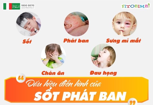 Sốt cao là triệu chứng điển hình của bệnh