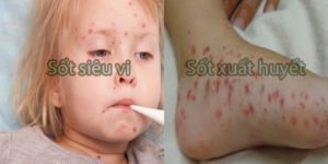 Hai bệnh đều rất hay gặp ở trẻ