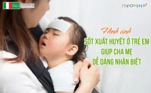 Hình ảnh sốt xuất huyết ở trẻ em giúp cha mẹ dễ dàng nhận biết