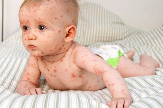 Nhiễm virus có thể khiến trẻ bị sốt