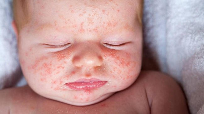Sau sốt trẻ thường bị phát ban trên toàn cơ thể