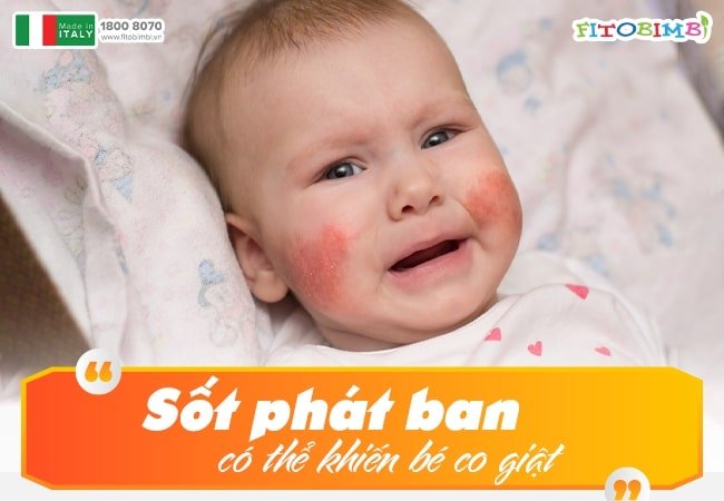 Sốt phát ban kéo dài có thể gây nhiều biến chứng