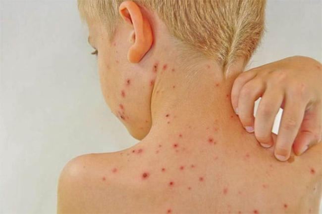 Sốt siêu vi phát ban ở trẻ: Những lưu ý không thể bỏ qua!