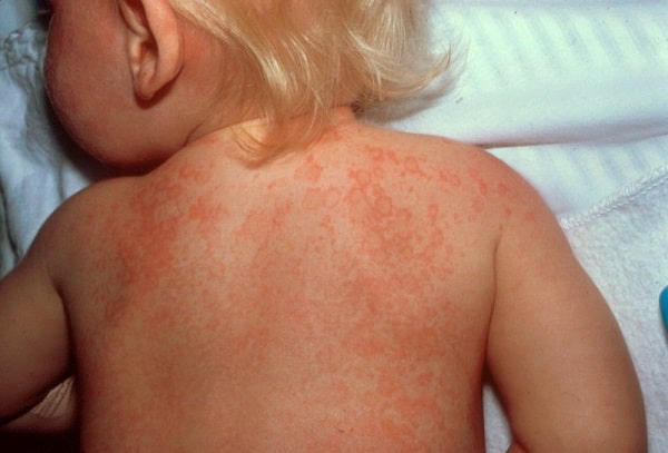 Tình trạng sốt siêu vi ở trẻ thường do virus gây ra