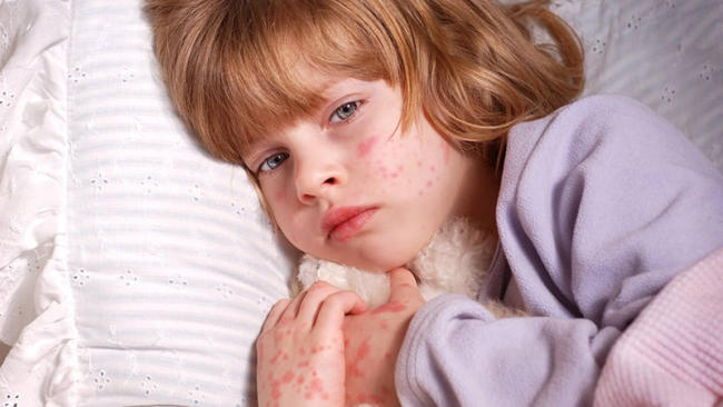 Trẻ bị nổi mề đay phát ban nhưng không sốt