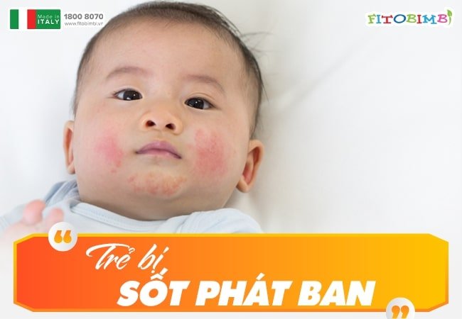 Trẻ sơ sinh rất dễ bị sốt phát ban