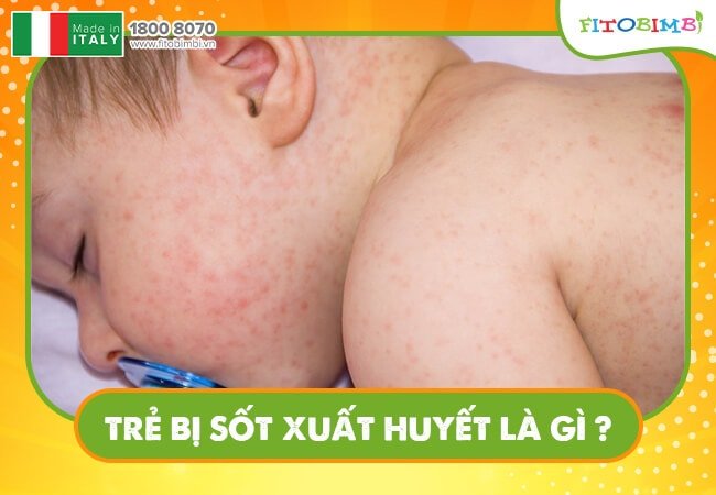 Sốt xuất huyết ở trẻ