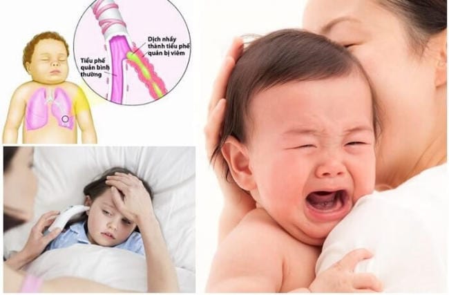 Trẻ sẽ có thể viêm phế quản khi sốt siêu vi