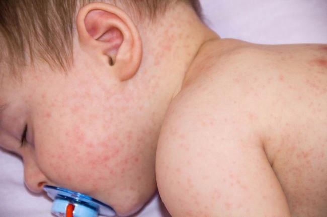 Trẻ sơ sinh rất dễ bị sốt phát ban