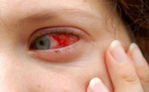 Trẻ sốt xuất huyết có thể gặp biến chứng ở mắt