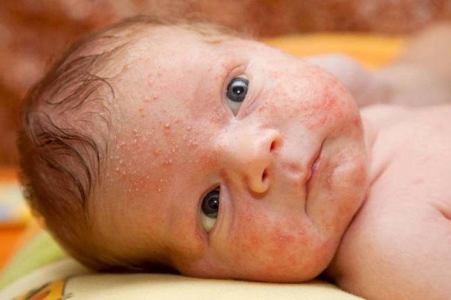 Viêm da tiếp xúc khiến trẻ phát ban nhưng không bị sốt