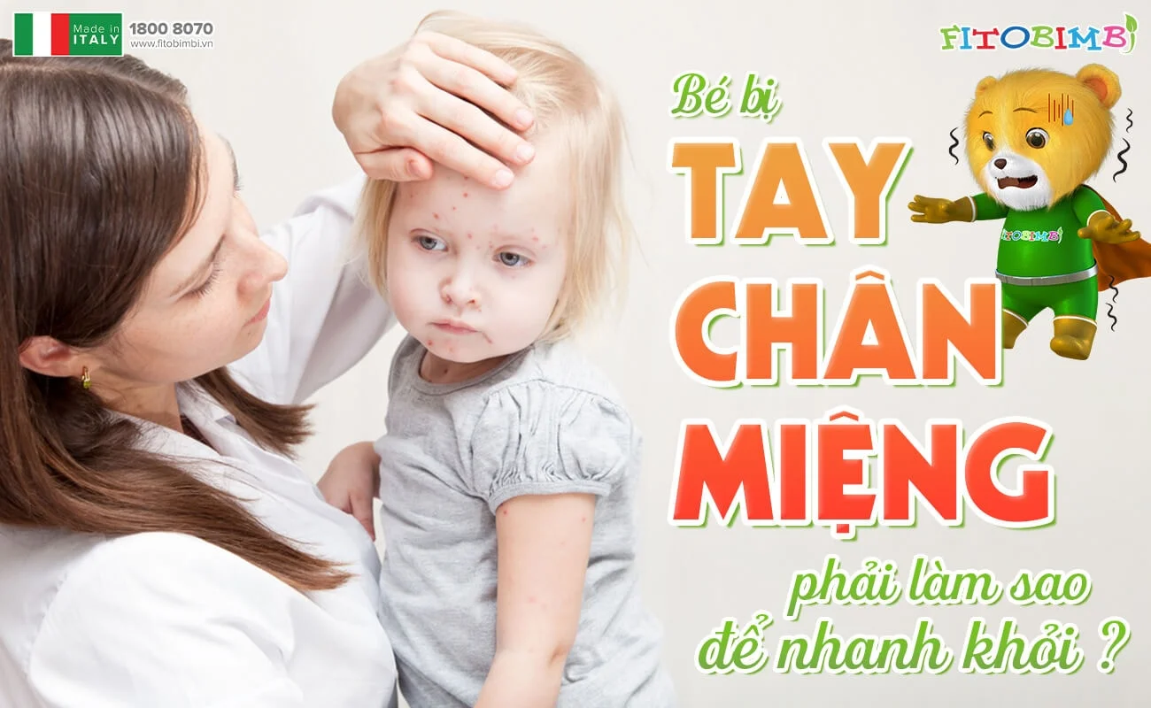 Vào mùa, bé bị tay chân miệng phải làm sao để nhanh khỏi?