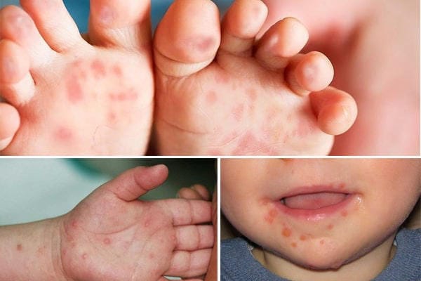 Bệnh tay chân miệng ở trẻ đặc trưng bởi nốt phát ban
