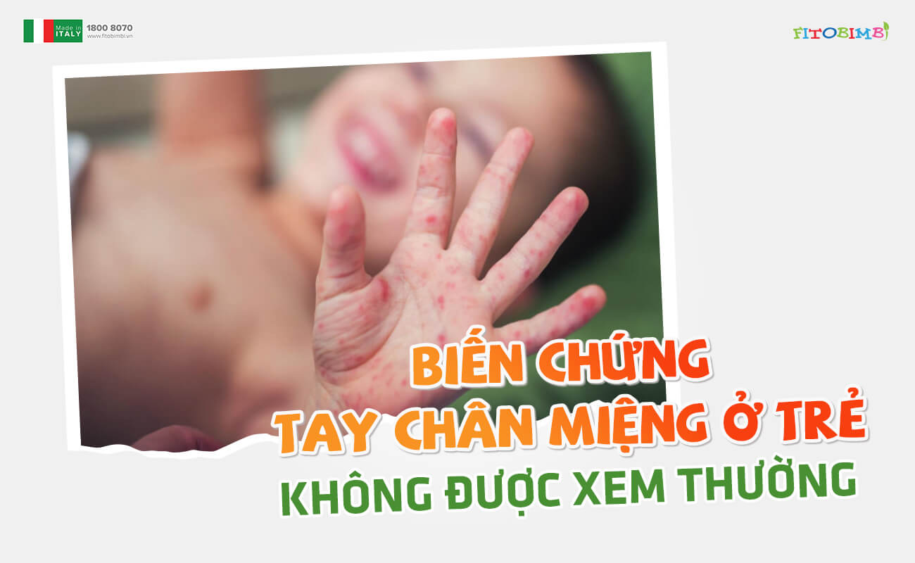 Những biến chứng tay chân miệng ở trẻ KHÔNG ĐƯỢC XEM THƯỜNG
