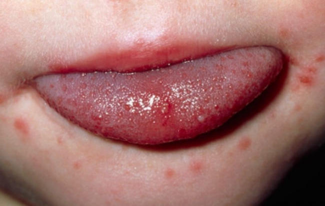 Bọng nước xuất hiện ở niêm mạc lưỡi khiến trẻ đau đớn, khó chịu, ảnh hưởng đến khả năng ăn uống