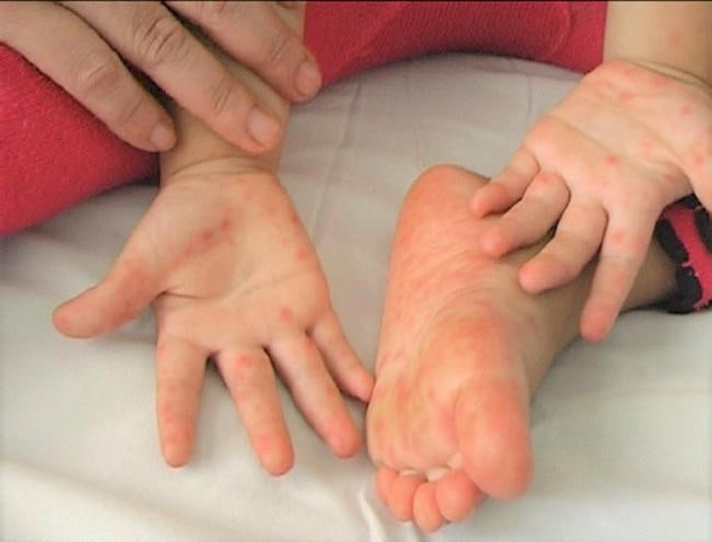 Các mụn nước nhỏ cũng xuất hiện trên bàn tay và bàn chân, thường là ở lòng bàn tay và lòng bàn chân