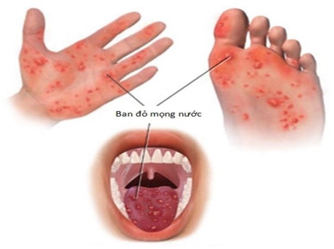 Đặc trưng của bệnh tay chân miệng là những nốt ban đỏ mọng nước