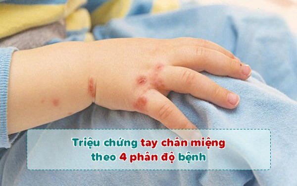 Giúp mẹ nhận biết 4 phân độ tay chân miệng ở trẻ để xử lý kịp thời