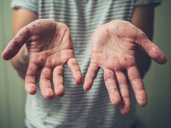 Nếu chủ quan, tay chân miệng ở trẻ có thể gây biến chứng nguy hiểm