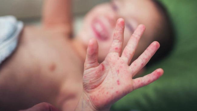 Nốt phát ban có thể vỡ, lây lan ra các vùng da khác trên cơ thể, hoặc lây cho trẻ khác nếu chạm phải