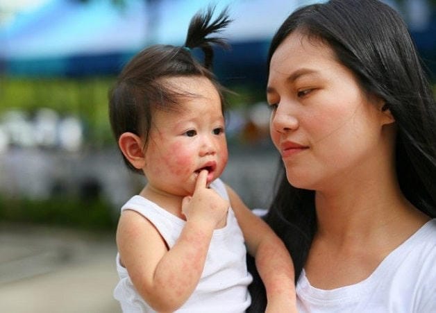 Trẻ nhỏ là đối tượng dễ bị căn bệnh này