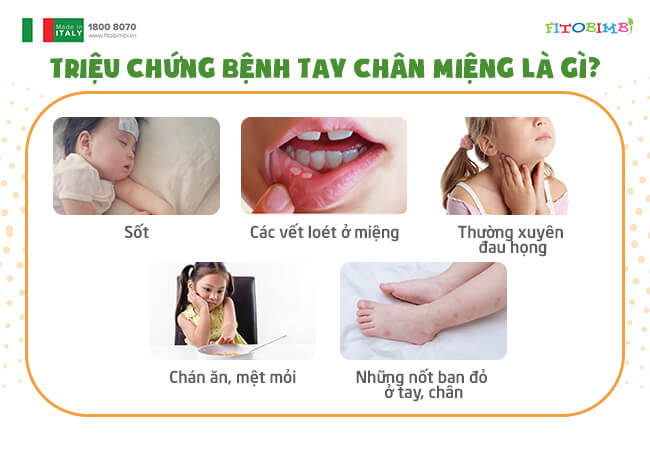 Dấu hiệu biến chứng tay chân miệng