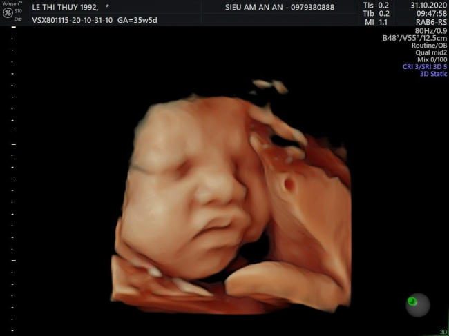 Adorable expressió d'un fetus de 36 setmanes