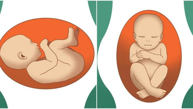 Điểm danh 9 nguyên nhân thai nhi không quay đầu