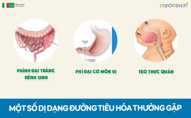 Ọc sữa cũng có thể là một dấu hiệu của dị dạng tiêu hóa