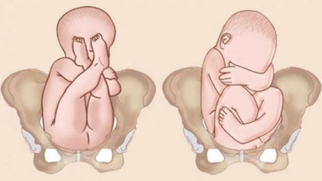 Thai nhi không quay đầu có thể gây biến chứng khi sinh