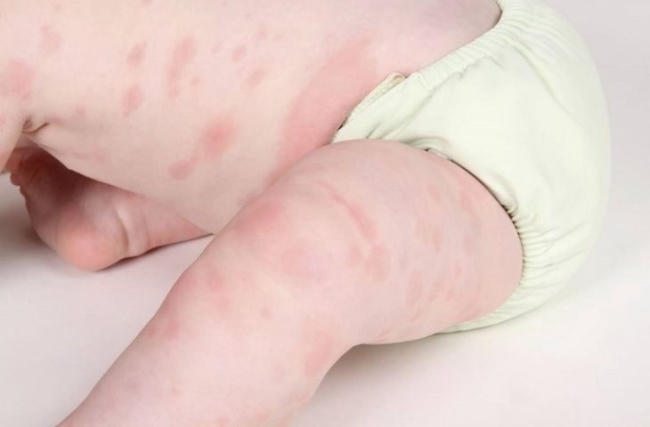 Lạm dụng nước dừa cho trẻ sơ sinh có thể viêm da