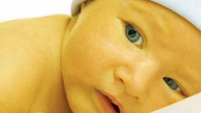 Biểu hiện vàng da sinh lý ở trẻ sơ sinh