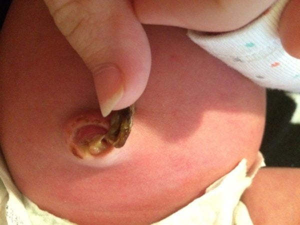 Hình ảnh rốn trẻ sơ sinh nhiễm trùng xuất hiện dịch mủ