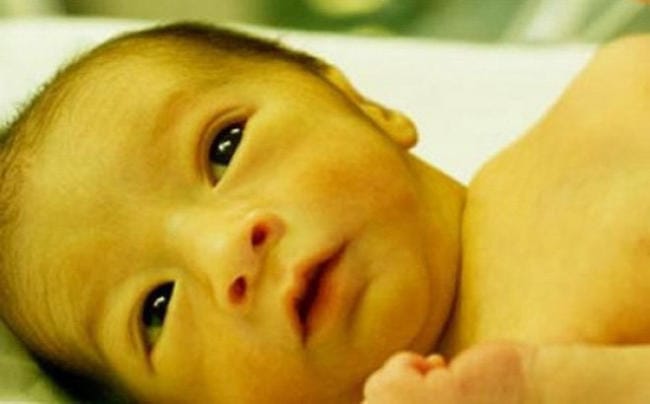 Biểu hiện vàng da ở trẻ sơ sinh