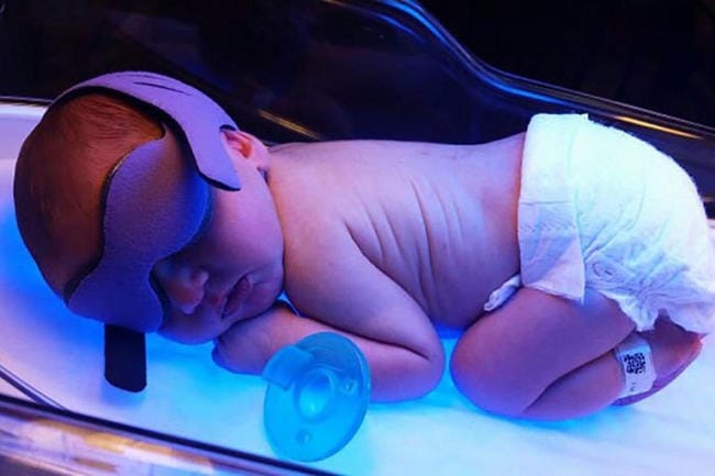 Chiếu đèn giúp làm giảm lượng Bilirubin cho bé