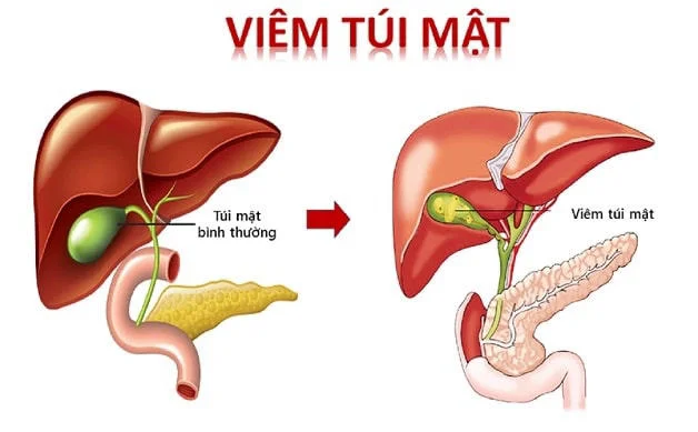Đau bụng bên phải có thể do viêm túi mật