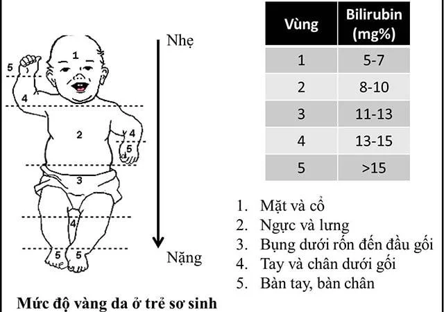 Dư thừa bilirubin là nguyên nhân khiến trẻ bị vàng da