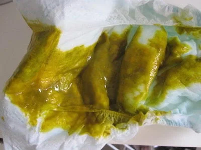 Hình ảnh phân sống của trẻ sơ sinh có nhầy và nước