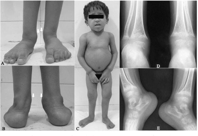 Trẻ bị còi xương chân thường biến dạng
