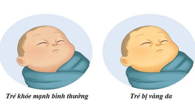 Trẻ bị vàng da kéo dài cần đưa đến bệnh viện ngay!