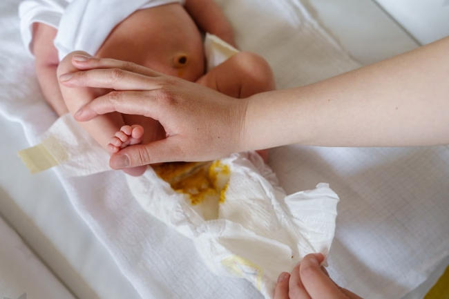 Trẻ sơ sinh đi ngoài có hạt vàng: Liệu có phải tình trạng đáng lo?