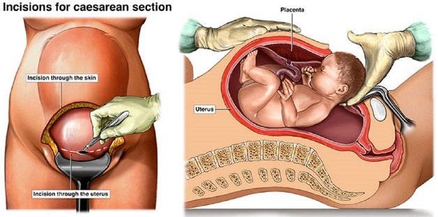 Ưu điểm của phương pháp sinh mổ