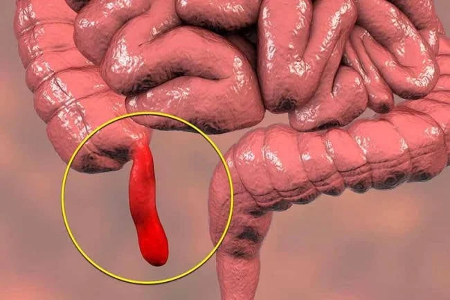 Viêm ruột thừa cần được cấp cứu ngay nếu không sẽ gây nguy hiểm tới tính mạng