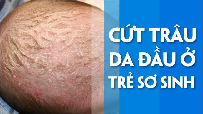 Cứt trâu ở trẻ sơ sinh: Dấu hiệu, nguyên nhân và cách chăm sóc