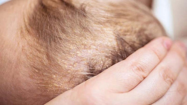 Hiện tượng cứt trâu ở trẻ sơ sinh hoàn toàn vô hại