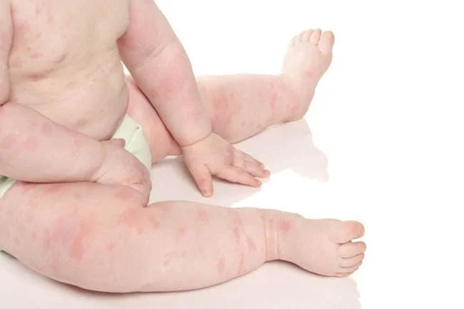 Giải mã nguyên nhân trẻ bị nổi mẩn đỏ như muỗi đốt
