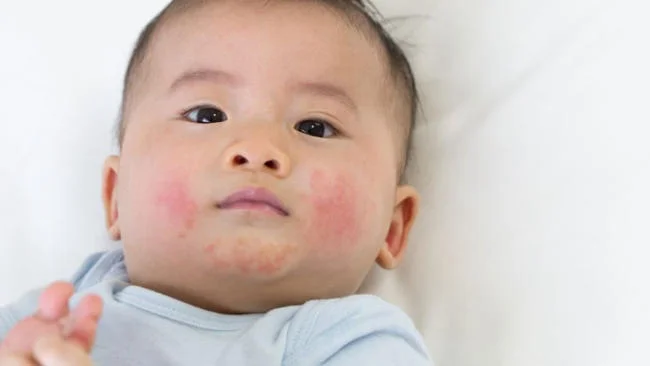 Trẻ bị bệnh chàm