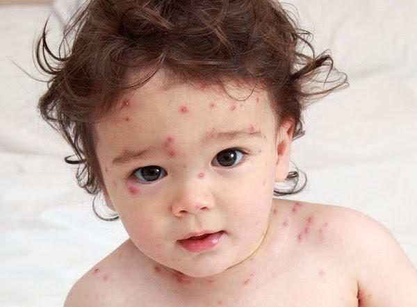 cách trị vết thâm muỗi đốt lâu ngày cho bé