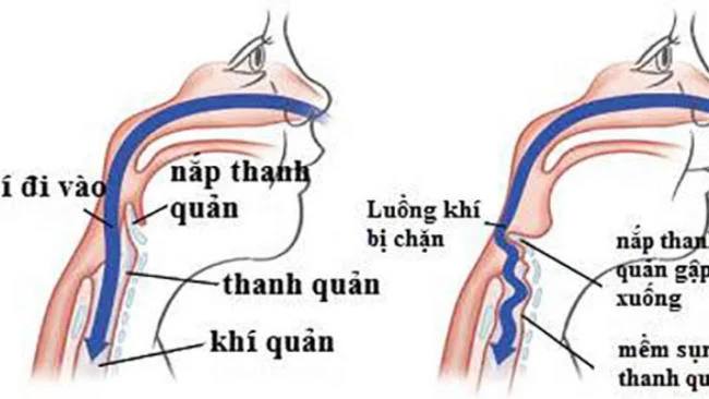 Dấu hiệu mềm sụn thanh quản