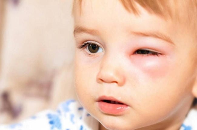 Cách chữa lẹo mắt ở trẻ em nhanh chóng, hiệu quả